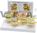 Four Stage Lumbar Vertebrae Set